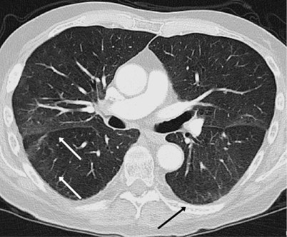 Akute Dyspnoe Subfebrile Temperaturen Und Schuttelfrost Bei Einem Patienten Mit Multiplem Myelom Springerlink