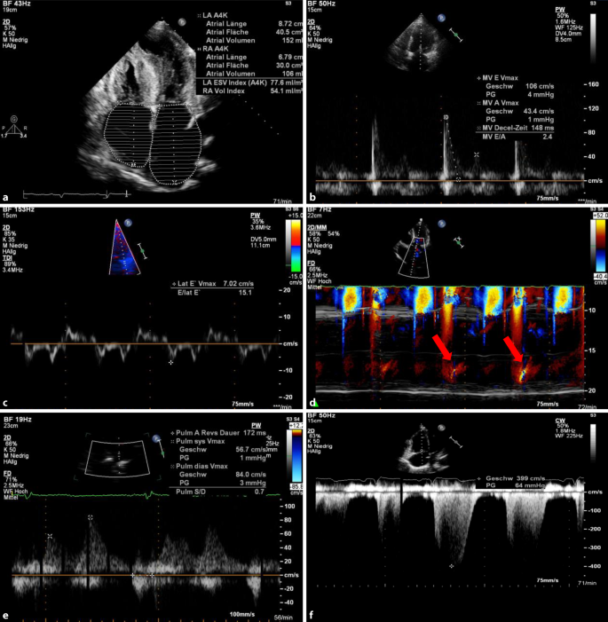Bettseitige Echokardiographische Evaluation Der Diastolischen Funktion Springerlink