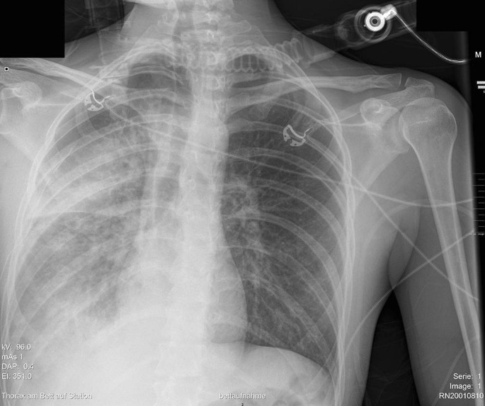 Fulminanter Verlauf Nach Anlage Einer Thoraxdrainage Nach Spontanpneumothorax Reexpansionsodem Trifft Anaphylaxie Springerlink