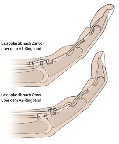 Operative Behandlung der Krallenhand mittels Lassoplastik | SpringerLink
