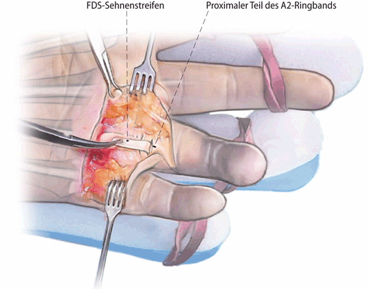 Schiene ulnarisrinnensyndrom Ulnarisrinnensyndrom