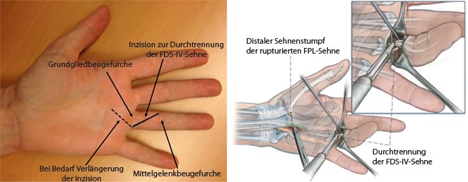 Wiederherstellung Der Daumenendgelenkbeugung Durch Transposition Der Oberflachlichen Beugesehne Des Ringfingers Springerlink