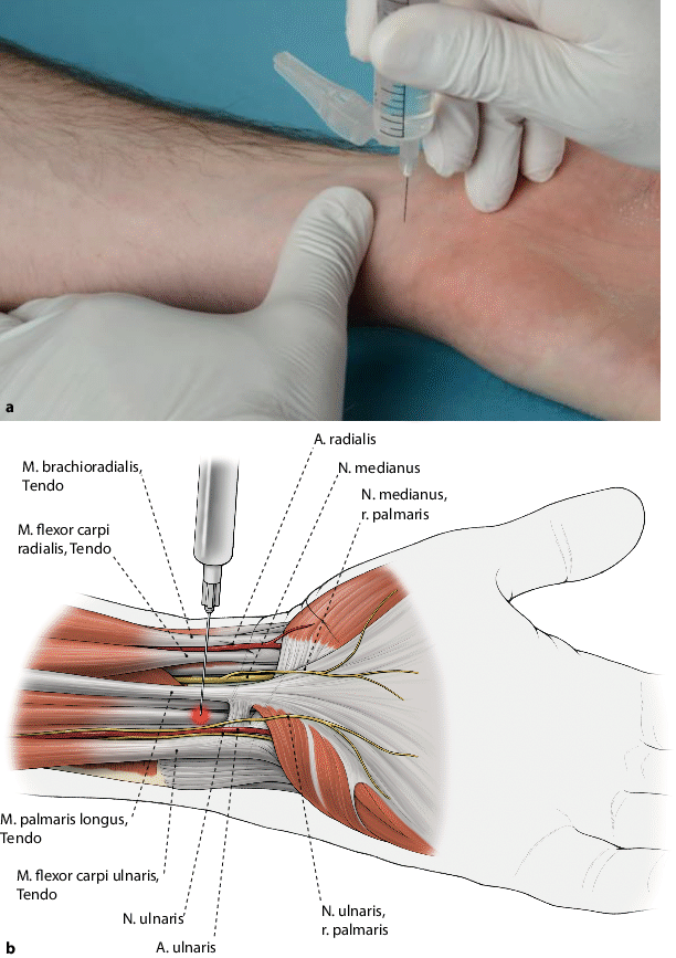 Wide-awake-Technik in der Handchirurgie anhand von Anwendungsbeispielen |  SpringerLink