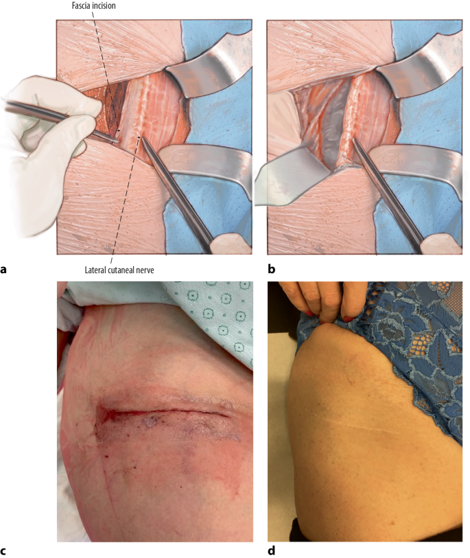 Direct anterior approach for total hip arthroplasty using the “bikini  incision” | SpringerLink