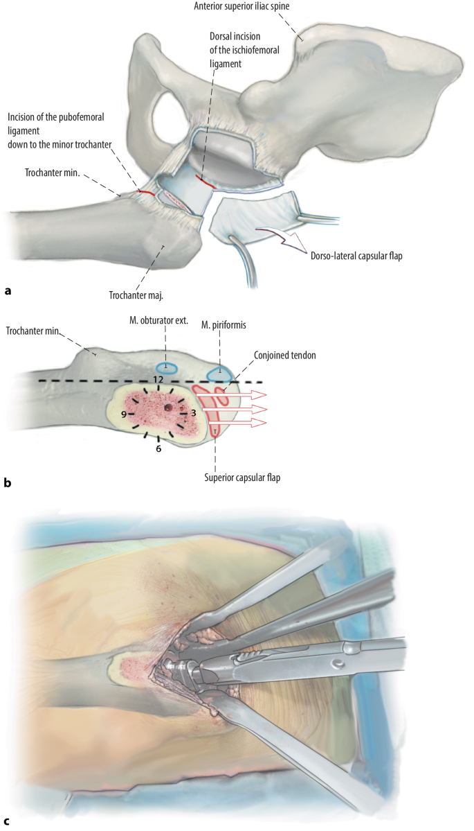 Short stem hip arthroplasty via the minimally invasive direct anterior  approach