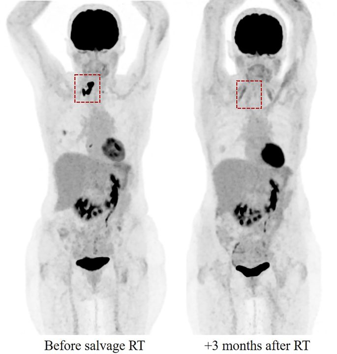 Tolerance of radiotherapy with concomitant glofitamab in diffuse large ...