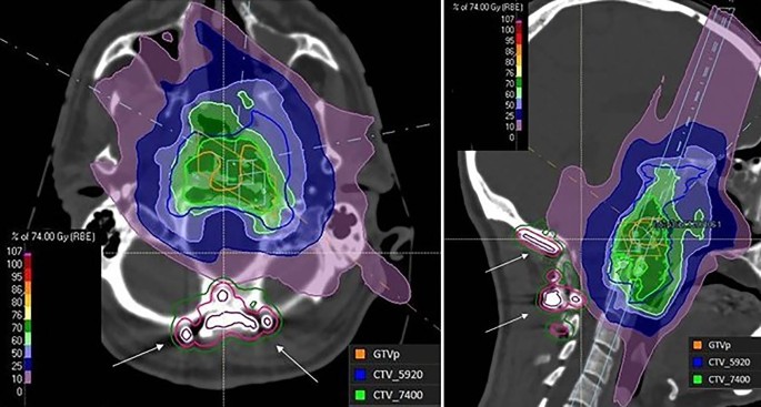 Robust IMPT and follow-up toxicity in skull base chordoma and 