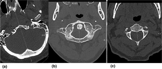 It Is The Lateral Head Tilt Not Head Rotation Causing An Asymmetry Of The Odontoid Lateral Mass Interspace Springerlink