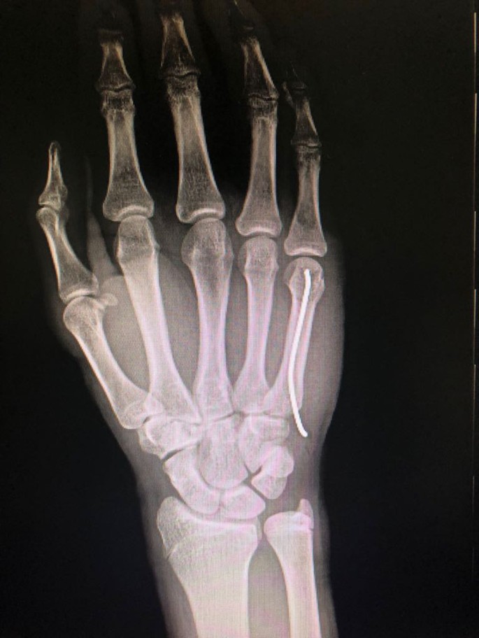 Metacarpal & Phalanx (Hand) Fracture Treatment, Plating & K-Wire Fixation in Jamshedpur | Dr. Pritpal Singh Saini