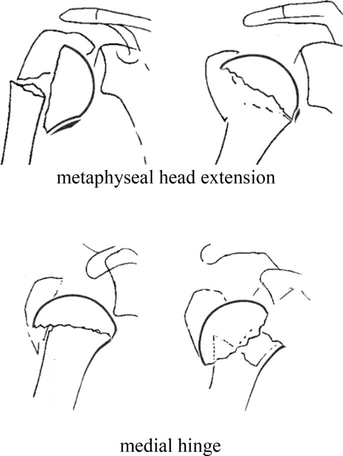Estes Recommendations On Proximal Humerus Fractures In The Elderly Springerlink