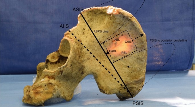 Osteology Of The Ilium Revised Illuminating The Clinical Relevance Springerlink