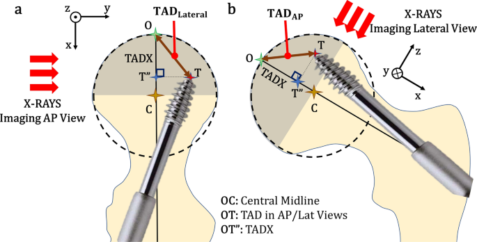 A Novel Lower Bound For Tip Apex Distance Springerlink