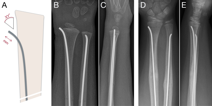 89 - Figure 8 - Fracture of the shaft of either radius or … | Flickr