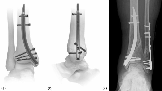 Retrograde tibial nailing of far distal tibia fractures: a biomechanical  evaluation of double- versus triple-distal interlocking | SpringerLink