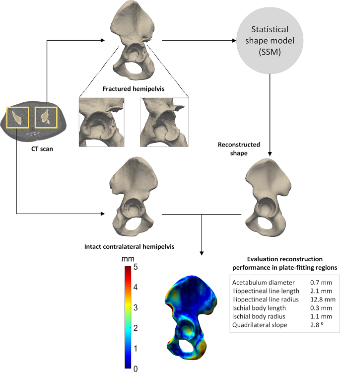 Automatic virtual reconstruction of acetabular fractures using a ...