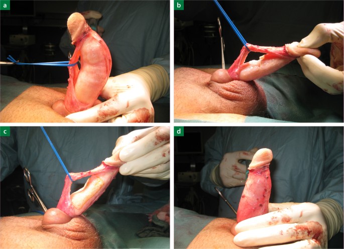 begradigen penis manuell gestreckt mit der hand
