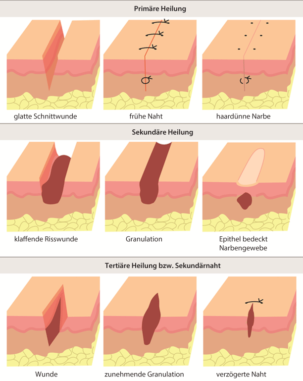 Grundlegende Techniken des Wundverschlusses in der Notaufnahme |  SpringerLink