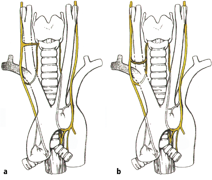 Rezidivparese des Nervus laryngeus