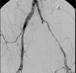 Verschlusse Der Aorta Und Der Beckenarterien Springerlink