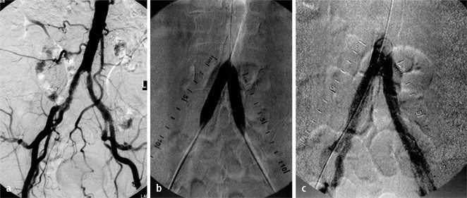 Verschlusse Der Aorta Und Der Beckenarterien Springerlink