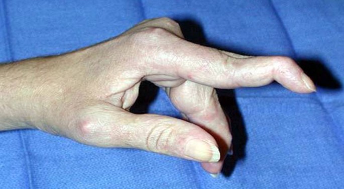 Strecksehnenverletzungen der Hand | SpringerLink