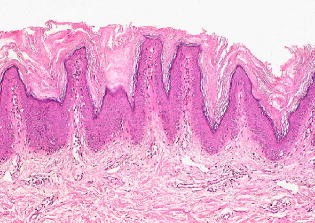 Papillomatosis reticularis et confluens