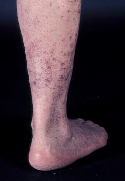 Generalisierte Purpura Als Dermatologische Manifestation Einer Thrombozytopenie Springerlink