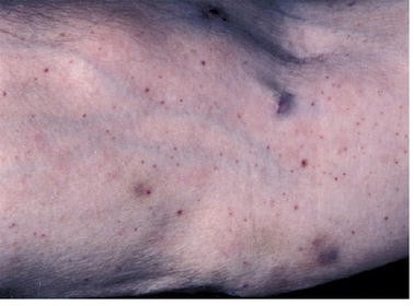 Generalisierte Purpura Als Dermatologische Manifestation Einer Thrombozytopenie Springerlink