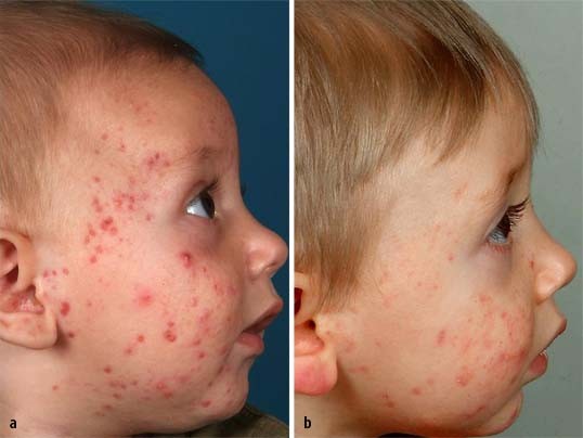 Systemische Retinoidtherapie bei schwerer Acne infantum | SpringerLink