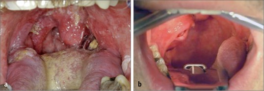 nem hpv pikkelyes papilloma méregtelenítési receptek