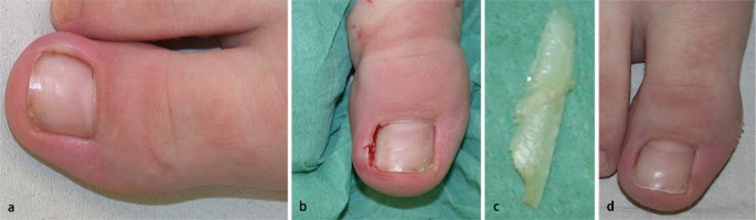 Nagelchirurgie bei Kindern | SpringerLink