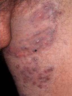 Herpes genitalis beim mann