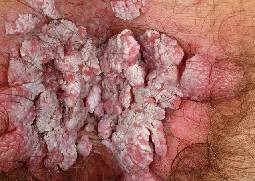 hpv impfung condylome