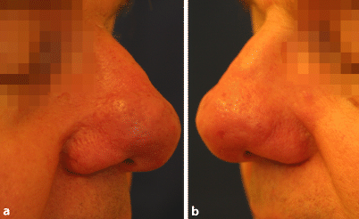 Rhinophym Springerlink