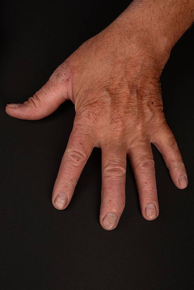 Wichtigste Kontaktallergene beim Handekzem | Die Dermatologie | Springer  Nature Link