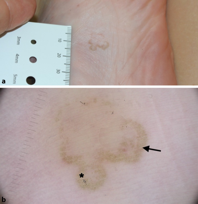 Suspekte Hyperpigmentierungen mit parallelem Leistenmuster an akraler Haut  | SpringerLink