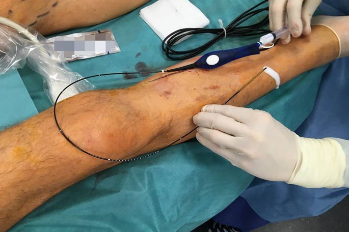 Operațiunea varicleoza din mashonki