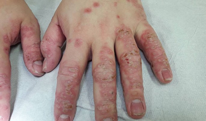 Atypische Hand-Fuß-Mund-Krankheit | SpringerLink