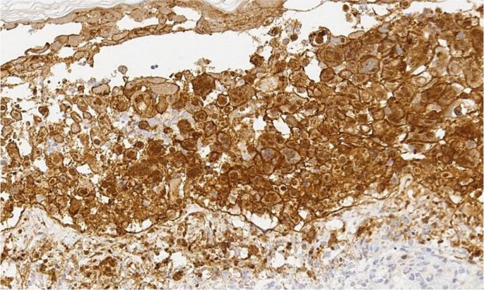 Impetiginisierte Erosive Plaques Bei Einem Patienten Mit Myasthenia Gravis Springerlink