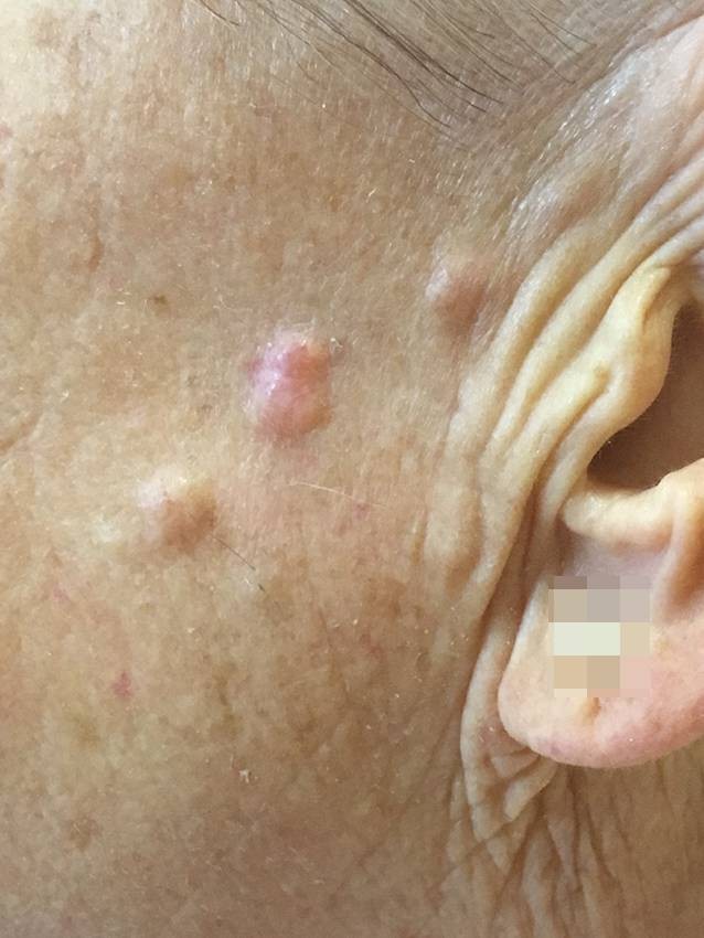 Merkel Zell Karzinom Bei Chronisch Lymphatischer Leukamie Springerlink