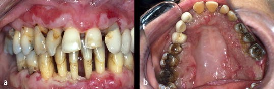 Ulzerierende Gingivostomatitis Und Parodontitis Springerlink