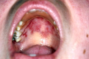 Ulzerierende Gingivostomatitis Und Parodontitis Springerlink