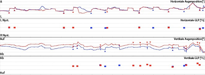 Schwindel durch Lärm oder Druck auf dem linken Ohr | SpringerLink