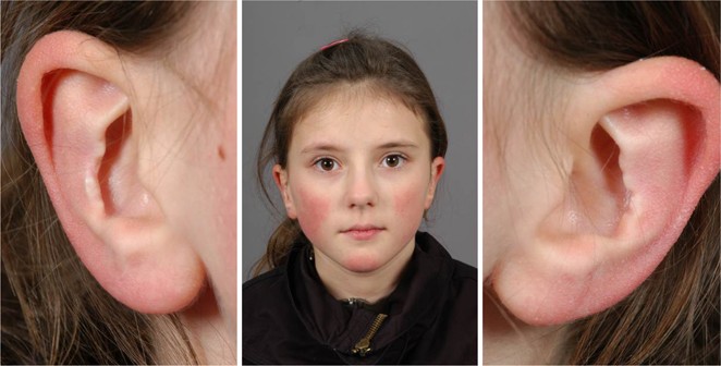 Korrektur von Ohrmuscheldeformitäten infolge Ohranlegeplastik | SpringerLink