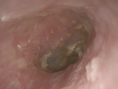 Ohrerkrankungen Und Diabetes Mellitus Springerlink
