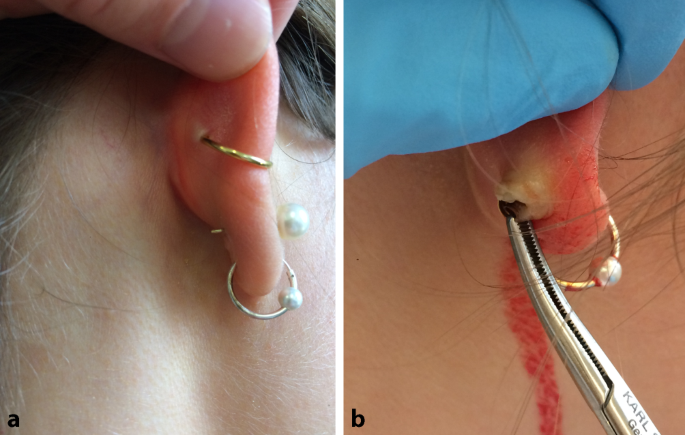 Komplikationen bei kosmetischen Piercings und Tätowierungen im  Kopf-Hals-Bereich | SpringerLink