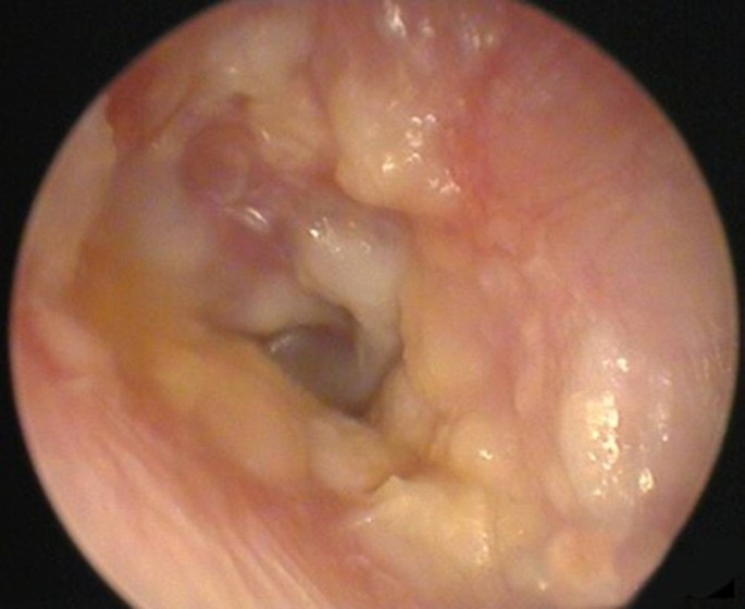 Diagnostik Und Behandlung Der Otitis Externa Springerlink