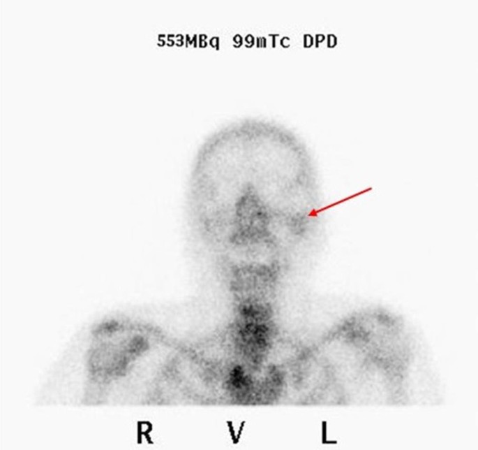 Diagnostik Und Behandlung Der Otitis Externa Springerlink