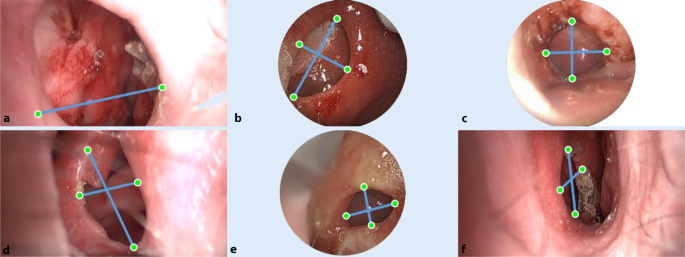 Endoscopic measurement of nasal septum perforations | SpringerLink