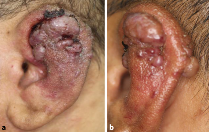 Rezidivierende Blutungen aus dem äußeren Ohr | SpringerLink